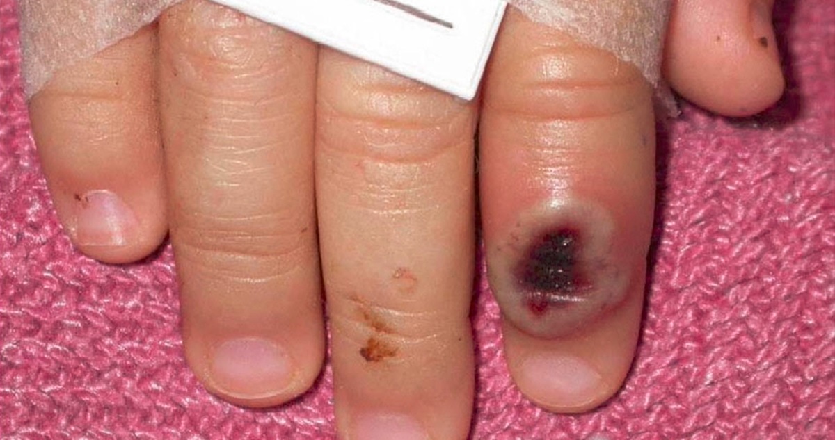 Foto mano con lesiones cutáneas por viruela del mono
