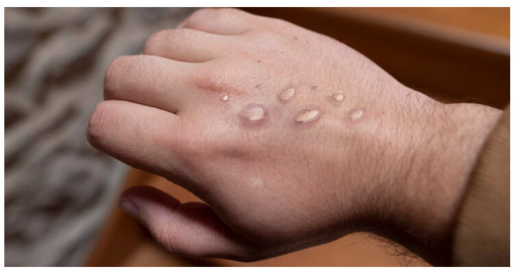 estudio-contagio-viruela-de-mono-superficie