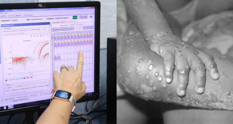 nuevos-sintomas-viruela-del-mono