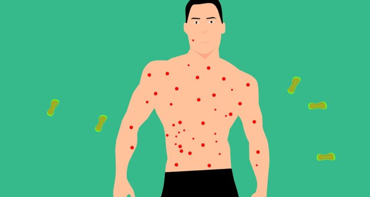 Imagen contexto viruela del mono