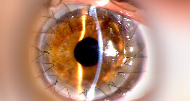 Implante de córneas a hombre