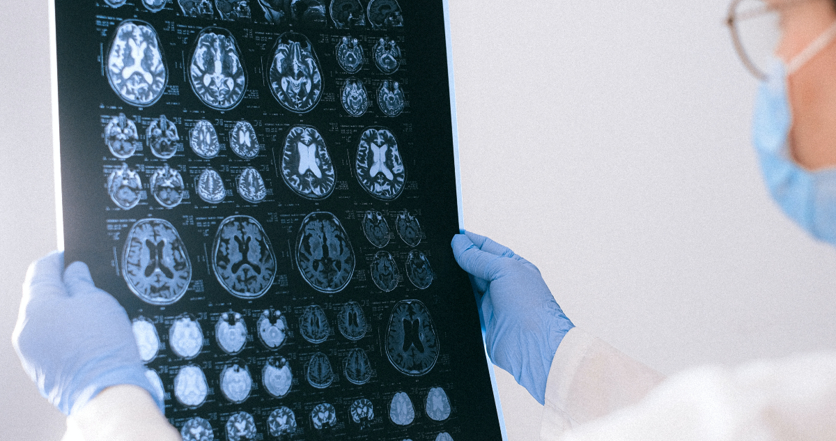 Alzheimer y salud mental