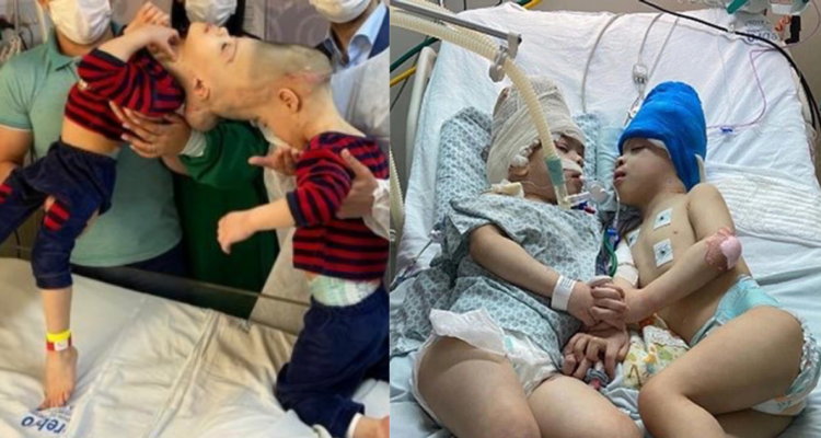 Gemelos siameses separados en Brasil