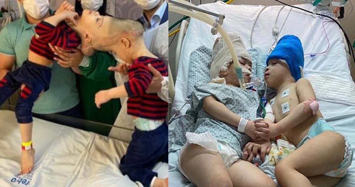 Gemelos siameses separados en Brasil