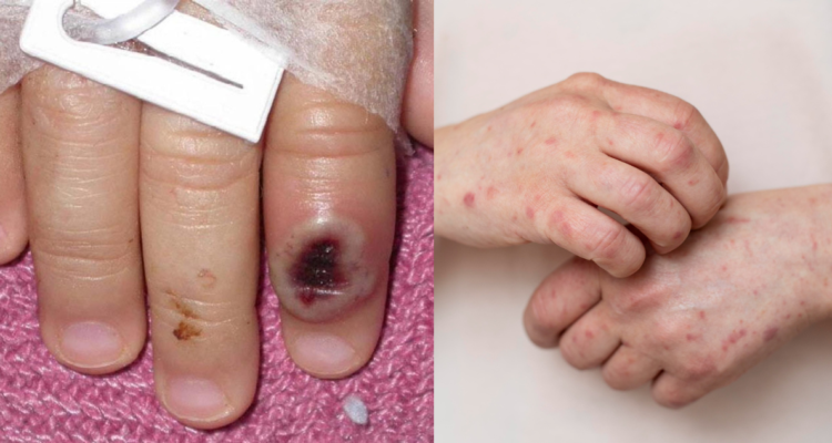 principal-via-de-contagio-viruela-del-mono