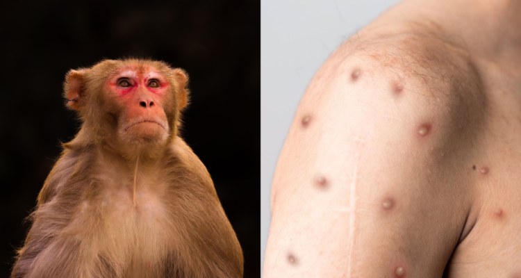 viruela-del-mono-casos-america