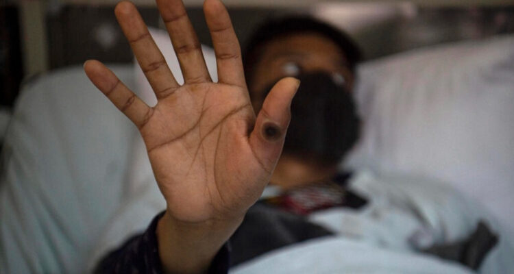 América se convierte en el epicentro del brote de la viruela del mono