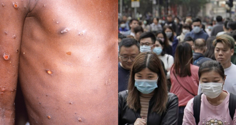 Chinos por viruela del mono