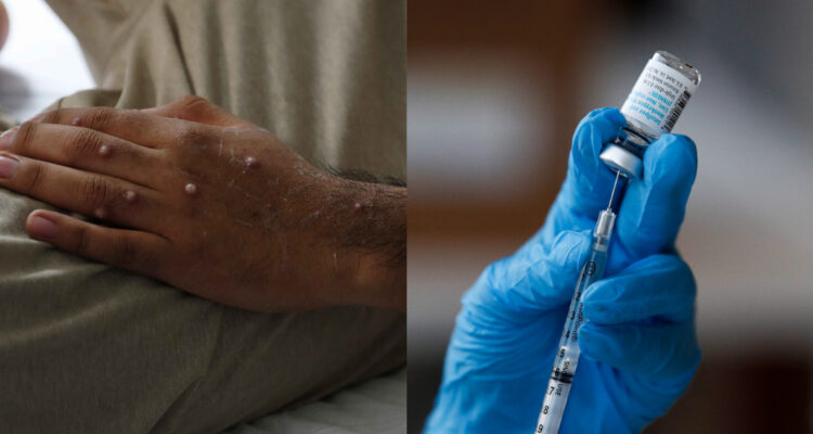 Columna de opinión UBO viruela del mono