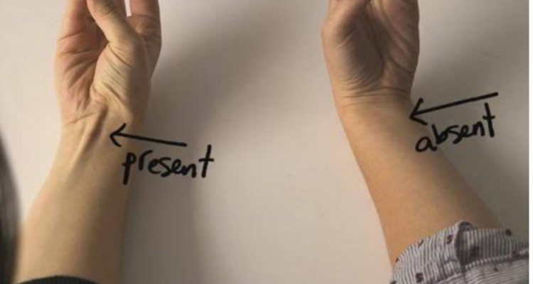 Persona con palmar largo y una que lo perdió