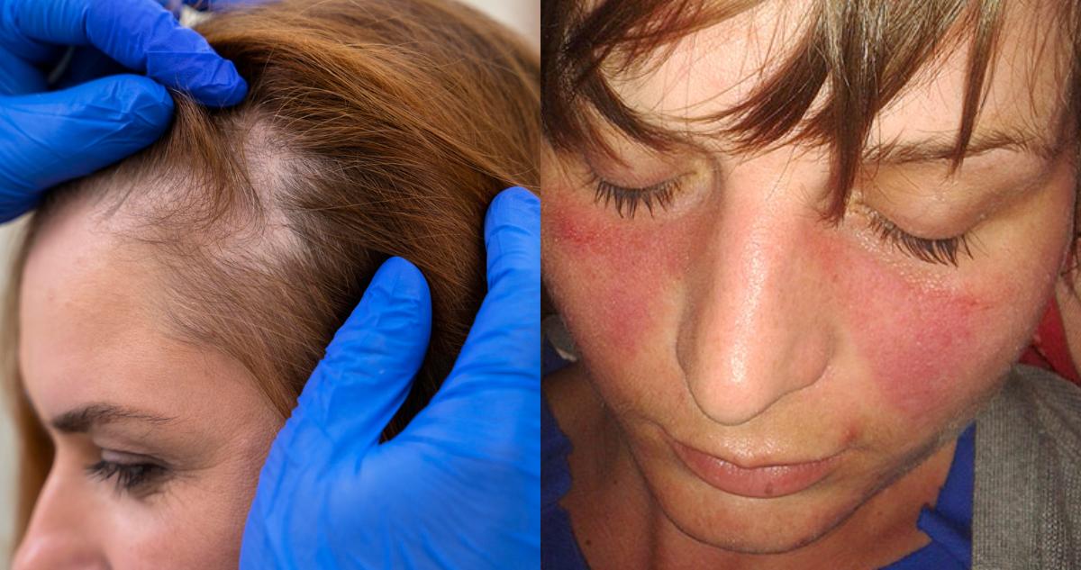 Persona con lupus con indicios de alopecia y erupciones en la cara con forma de mariposa, síntomas de la enfermedad del lupus