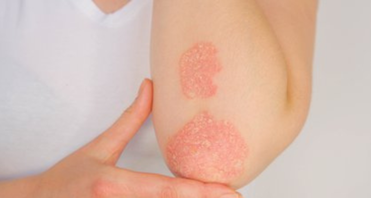 psoriasis
