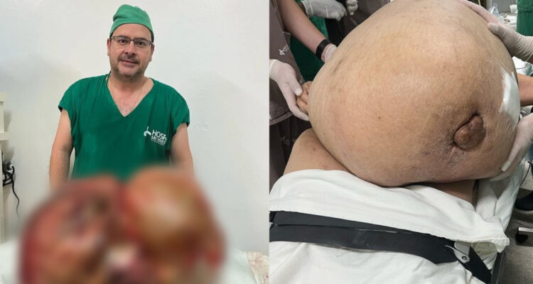 tumor de 46 kilos