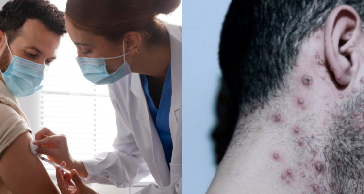 Persona siendo vacuna y persona con cicatrices de viruela