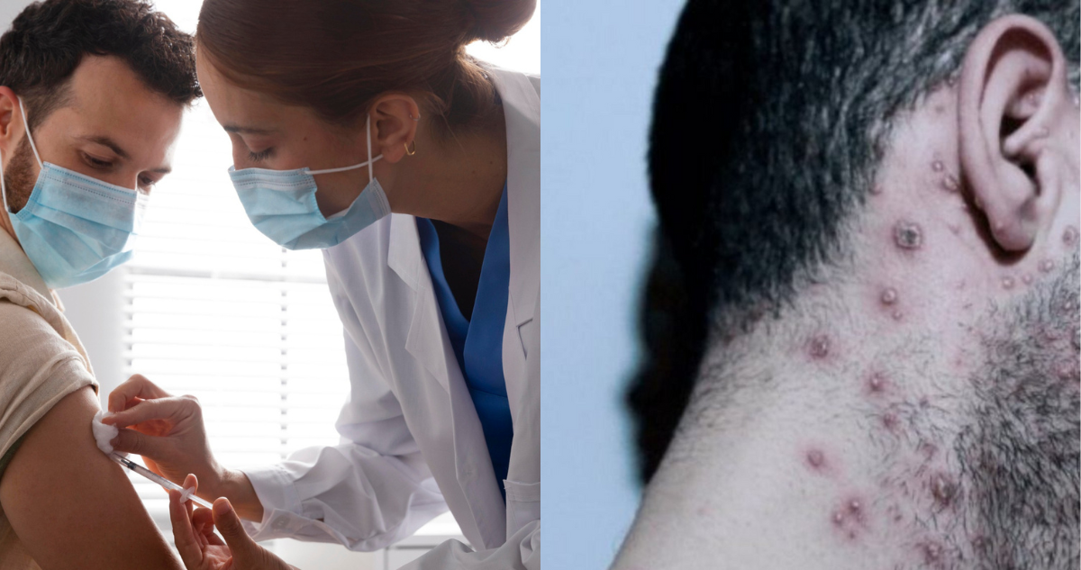 Persona siendo vacuna y persona con cicatrices de viruela