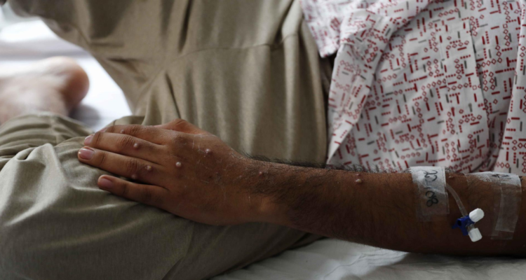 Persona infectada con viruela del mono con pústulas visibles en su brazo