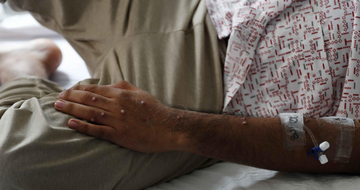 Persona infectada con viruela del mono con pústulas visibles en su brazo