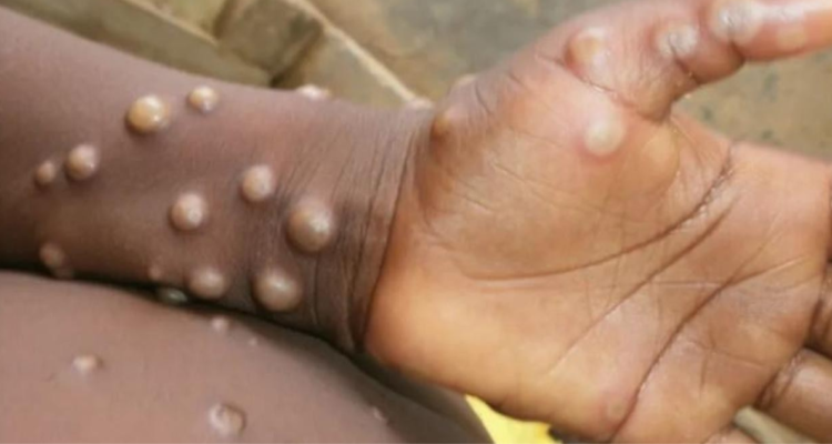 OMS y viruela del mono