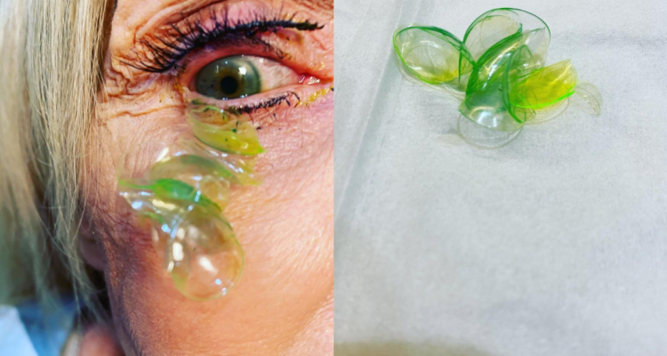 Retiran 23 lentes de contacto