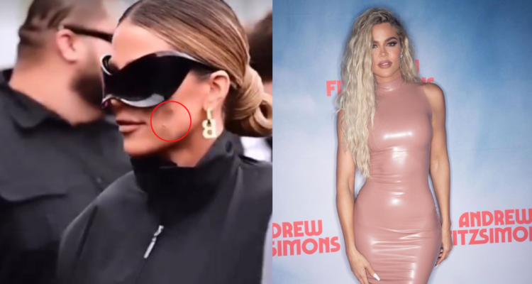 Khloe Kardashian usando un parche para cubrir la incisión hecha para la biopsia de su tumor (Izquierda); Khloe en un evento (derecha). Khloe Kardashian descubrió que tenía cáncer a la piel luego de confundir tumor con brote de acné