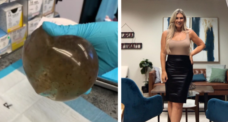 Implante mamaria con moho (Izquierda) y Melissa Lima, la paciente con “breast implants illness” (derecha)