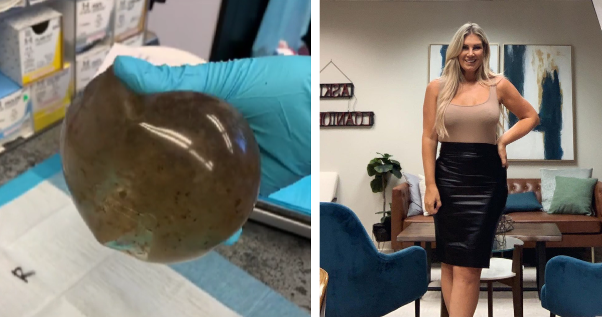 Implante mamaria con moho (Izquierda) y Melissa Lima, la paciente con “breast implants illness” (derecha)