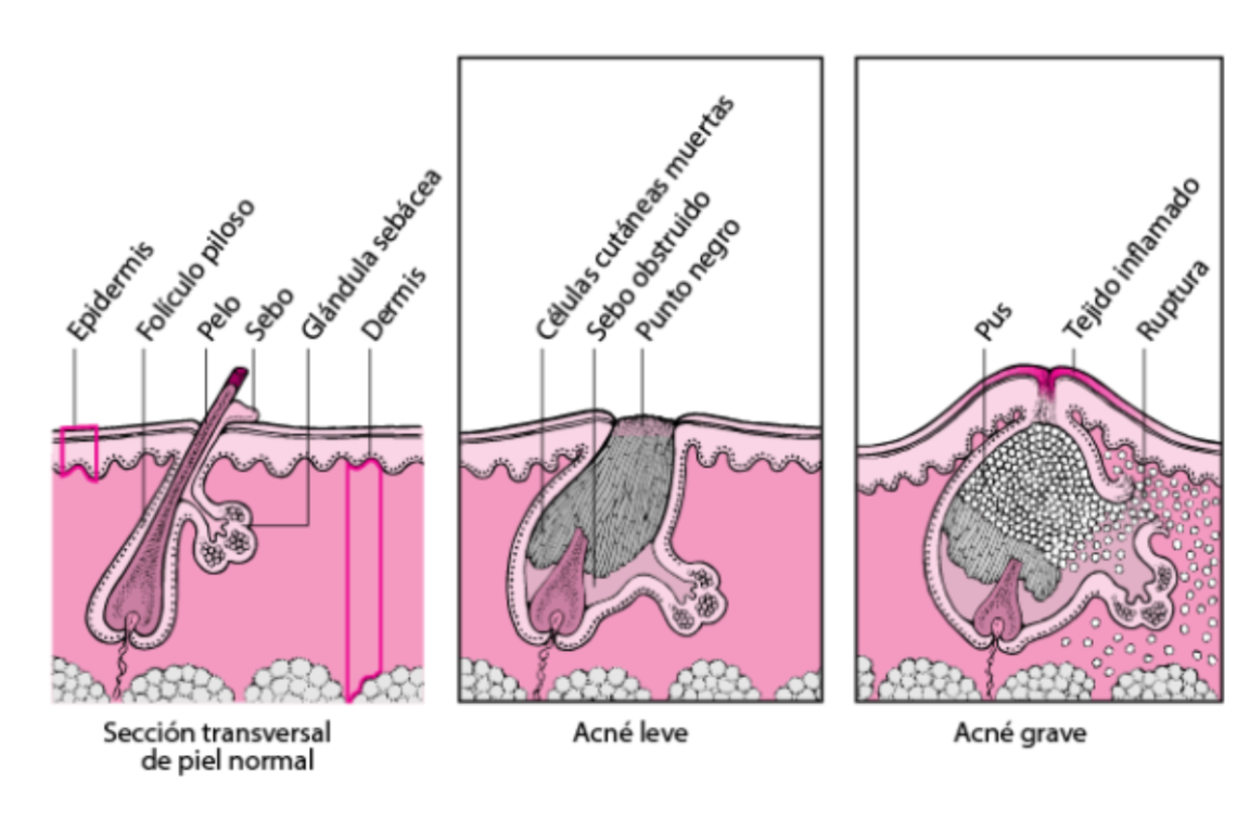 Illustration of types of acne: mild or severe.