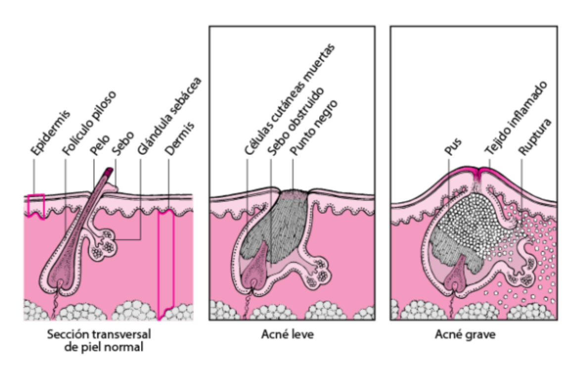 Ilustración de los tipos de acné: leve o grave.