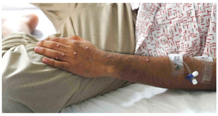 OMS CAMBIA DE NOMBRE A LA VIRUELA DEL MONO