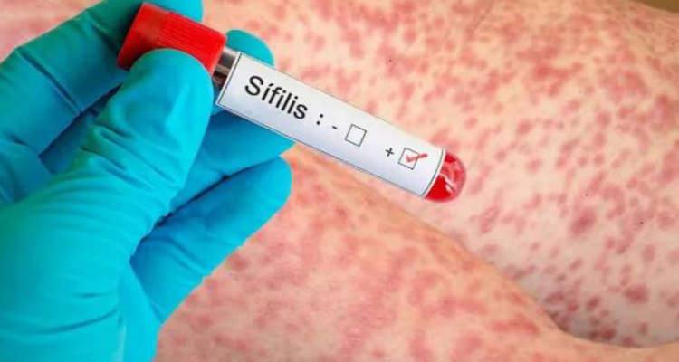 Síntomas de la sífilis