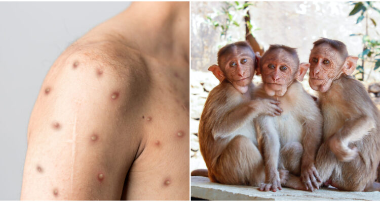 VIRUELA DEL MONO PODRÍA TRANSMITIRSE POR AIRE