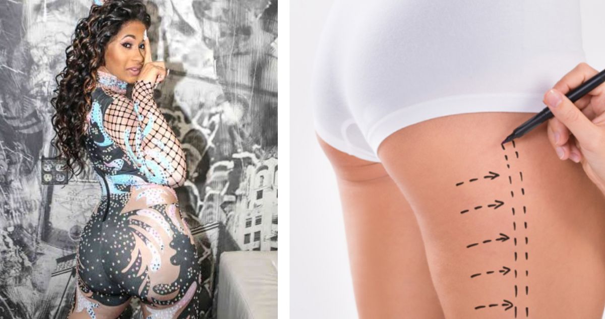 Qué son las inyecciones de biopolímeros: La cirugía de la que Cardi B se arrepiente