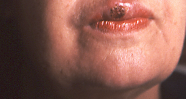 Mujer con chancro en la boca por infección con sífilis