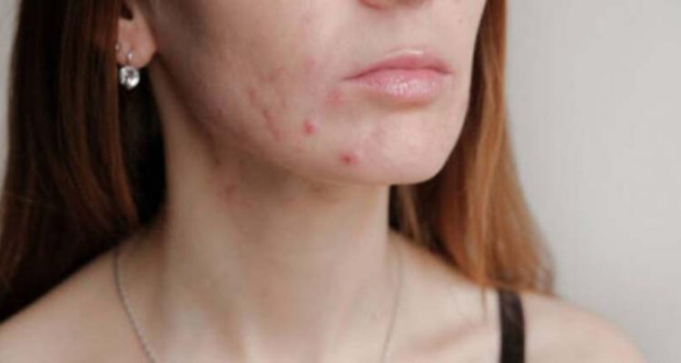 Por qué aparecen granitos en el mentón