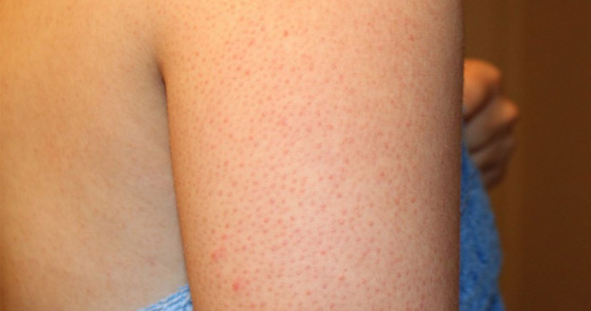 Queratosis pilar