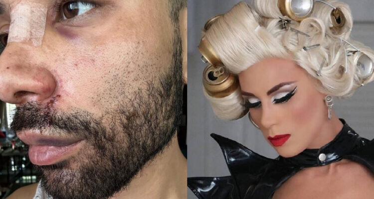 El intérprete de Luz Violeta, Sebastián Aguirre, mostrando heridas en su rostro. A su lado, una foto bajo su personaje.