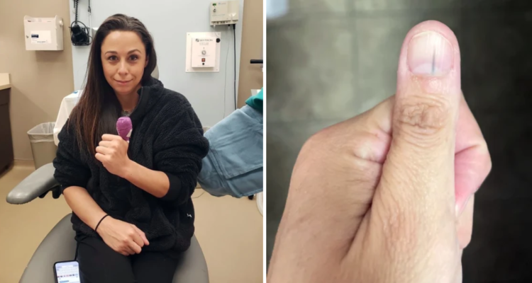 Charmaine Sherlock, mujer que descubrió que tenpia cáncer a la piel luego de que una linea oscura apareciera en su uña pulgar
