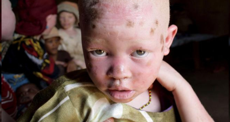 Secuestros de albinas en Madagascar