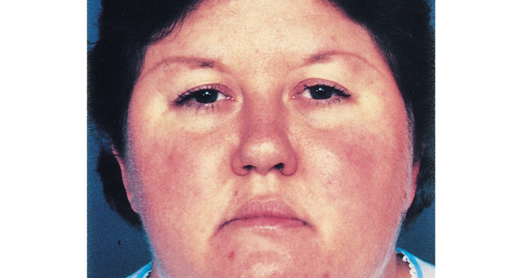 Mujer con "cara de luna llena", síntoma producido por el síndrome de Cushing