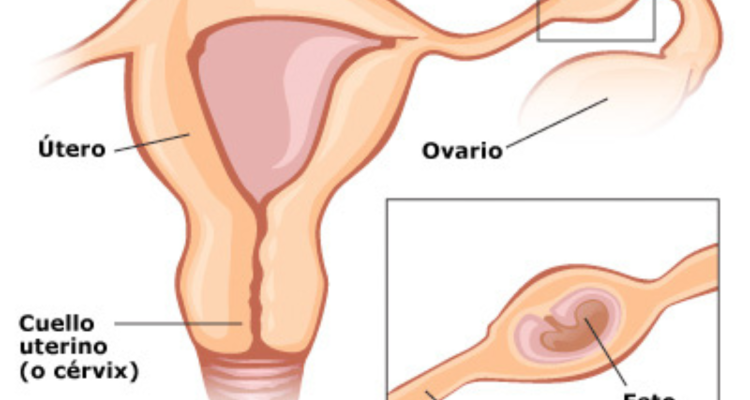 Ilustración de un embarazo tubárico, un tipo de gestación ectópica