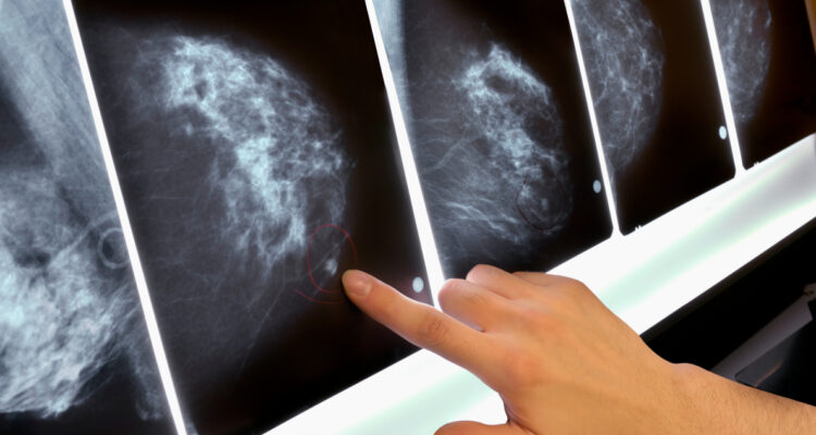 Laboratorio penquista falsificó exámenes y entregó falsos diagnósticos de cáncer