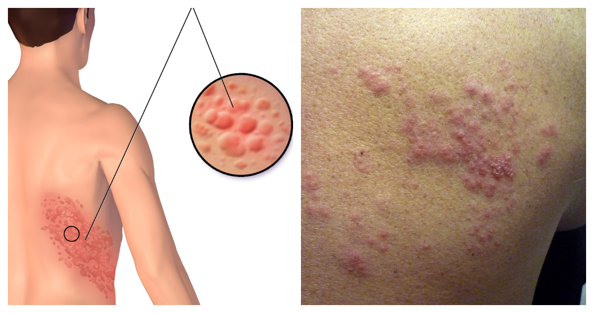 HERPES DE ZOSTER