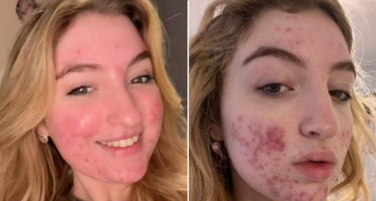 Influencer con acné eliminada de TikTok