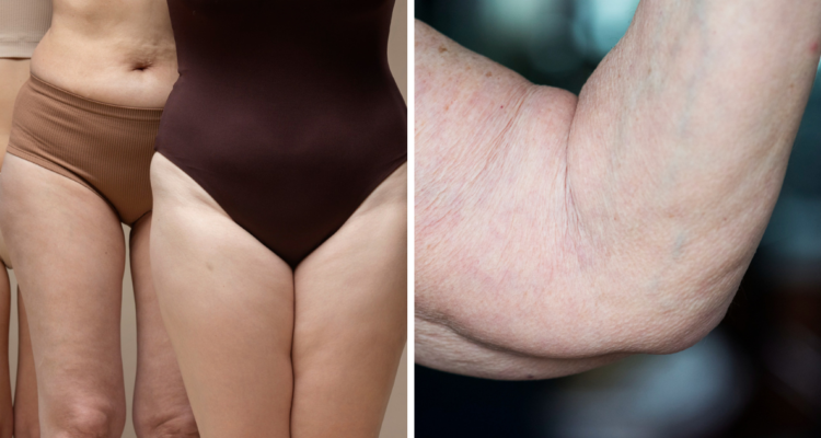 Mujeres con acumulación de grasa en piernas (izquierda) y en los brazos (derecha) en referencia al trastorno de Lipedema y cómo se trata en Chile
