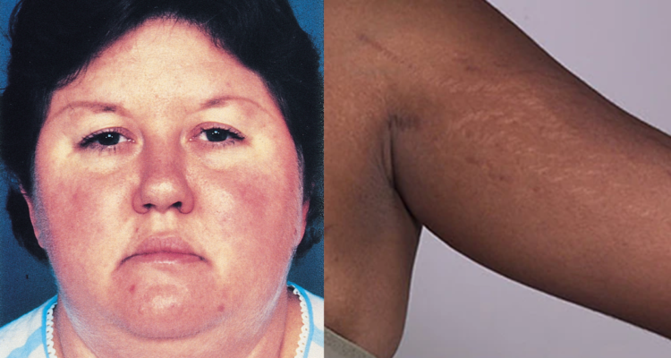 Mujer con “cara de luna llena” (izquierda) y otra con estrías en los brazos (derecha) ambos síntomas del síndrome de Cushing