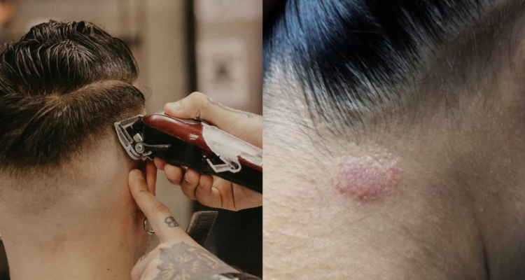 Tiña en peluquerías de España