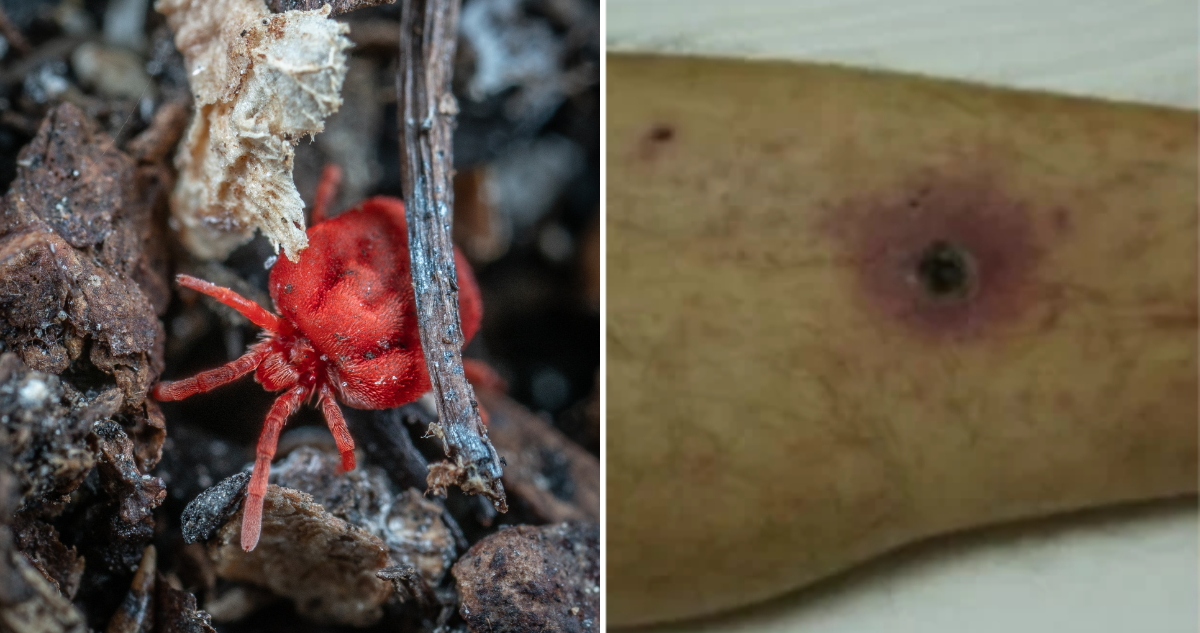 Acaro (izquierda) y lesiones cutáneas por tifus de matorrales (derecha)