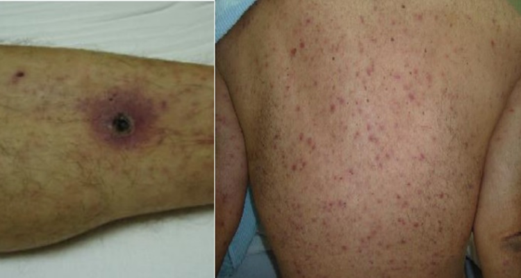 Decretan alerta epidemiológica por tifus de los matorrales enfermedad se expande en el sur del país