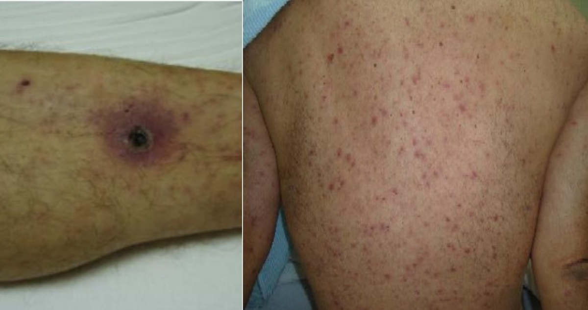 Decretan alerta epidemiológica por tifus de los matorrales enfermedad se expande en el sur del país