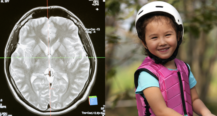 radiografía cerebral (izquierda) y fotografía de Rylae-Ann Poulin, niña que volvió a caminar tras terapia genética intracerebral